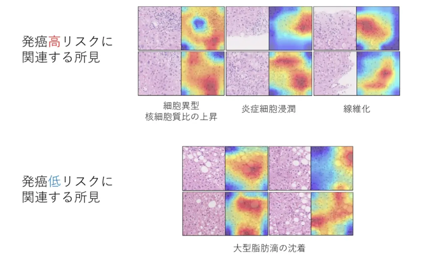 XAIが注目した肝がん発症に関連する病理学的所見