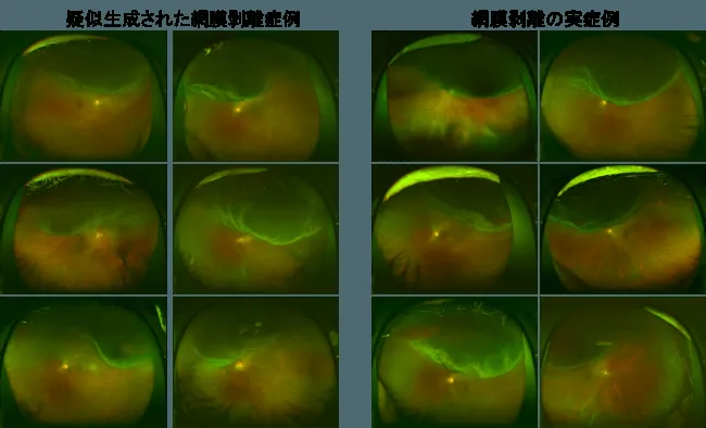 AIが作った網膜剥離症例画像