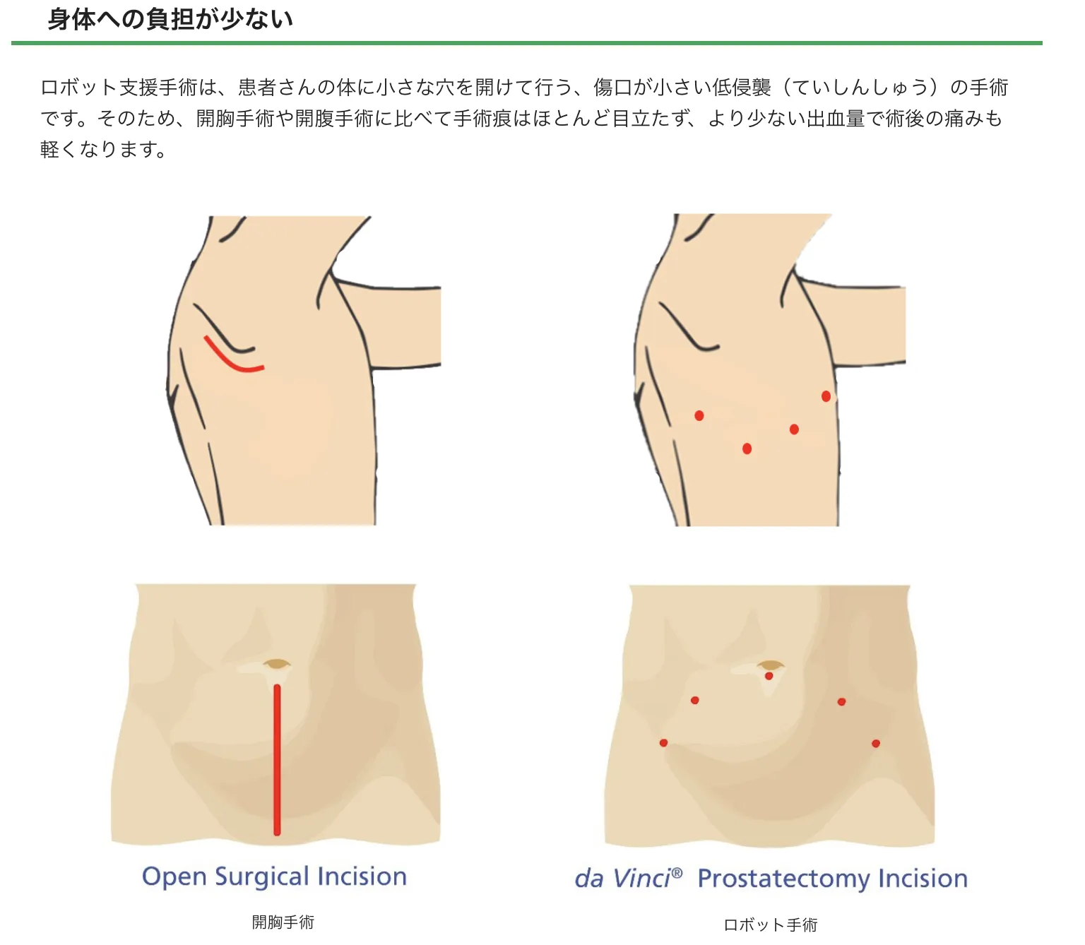 開胸手術（左）とロボット手術（右）の傷口の違い